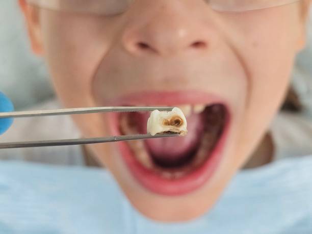 Best Emergency Tooth Extraction in Balch Springs, TX