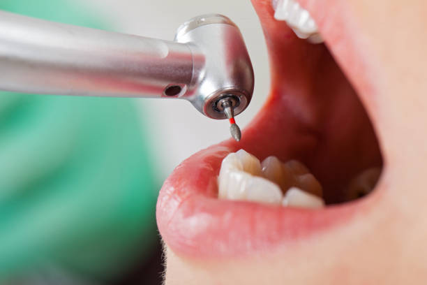 Best Emergency Wisdom Teeth Removal in Balch Springs, TX